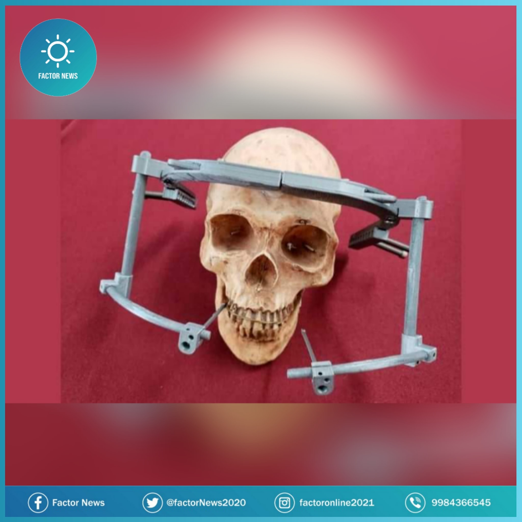 Mexicano crea dispositivo impreso en 3D para corregir deformaciones craneales.